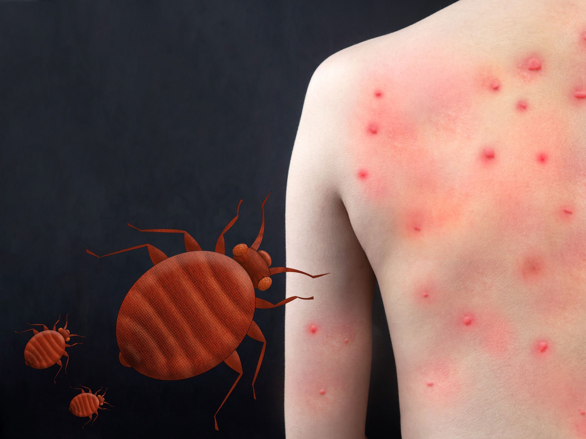 Bedbug bite on the human body. Itchy, red spots on the skin caused by insect bites. Cimex lectularius is a species of domestic blood-sucking insect.